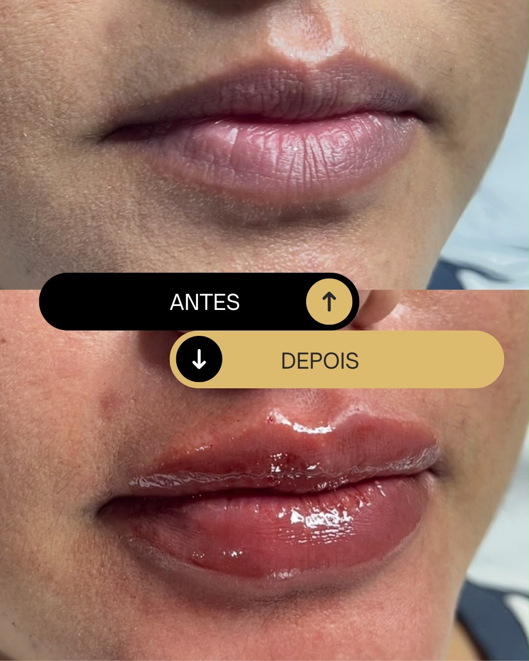 Preenchimento labial com ácido hialurônico antes e depois — volume