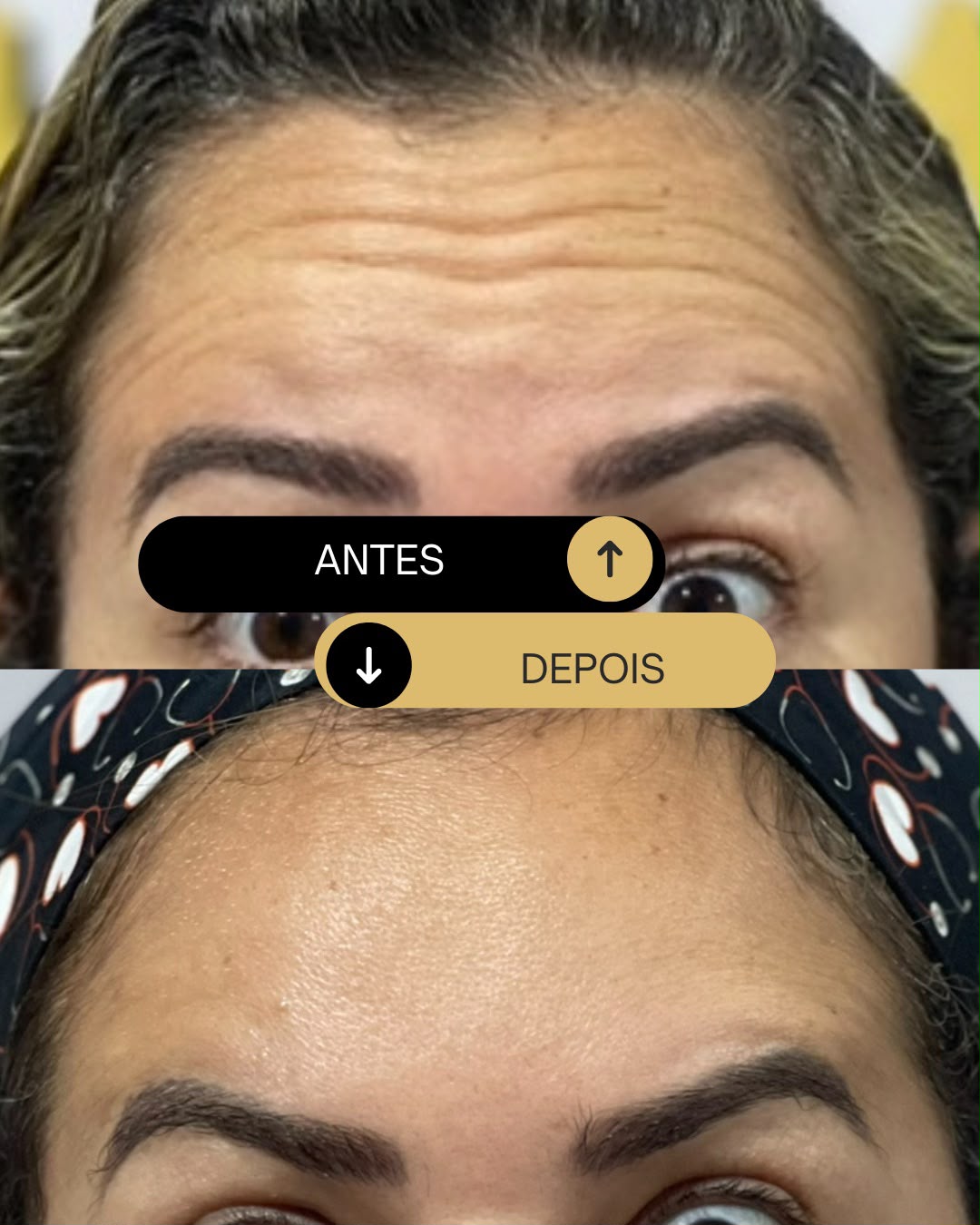 Botox antes e depois — rugas da testa