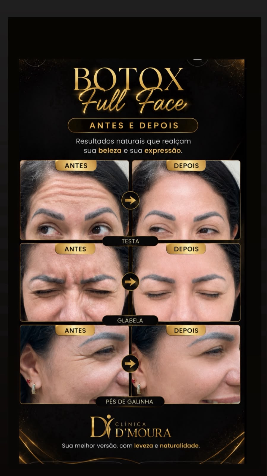 Botox Full Face antes e depois — testa, glabela e pés de galinha
