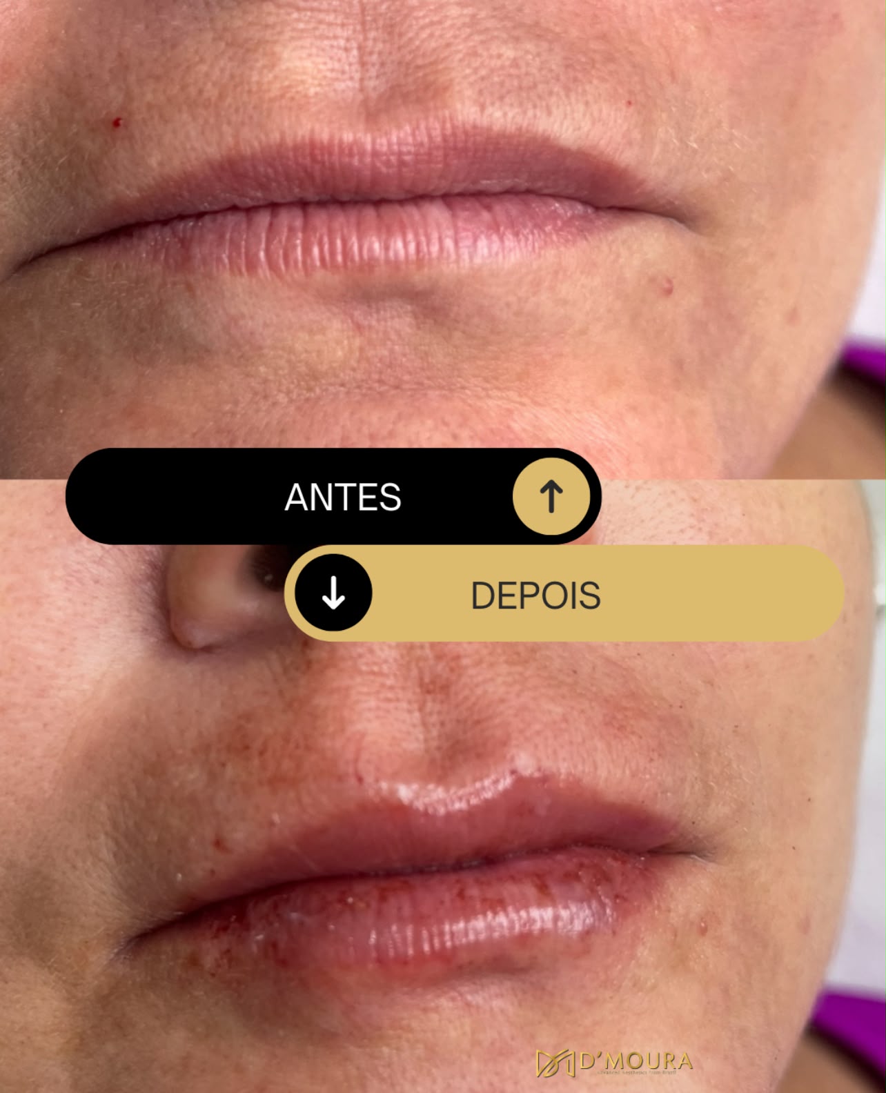 Preenchimento labial com ácido hialurônico antes e depois — definição