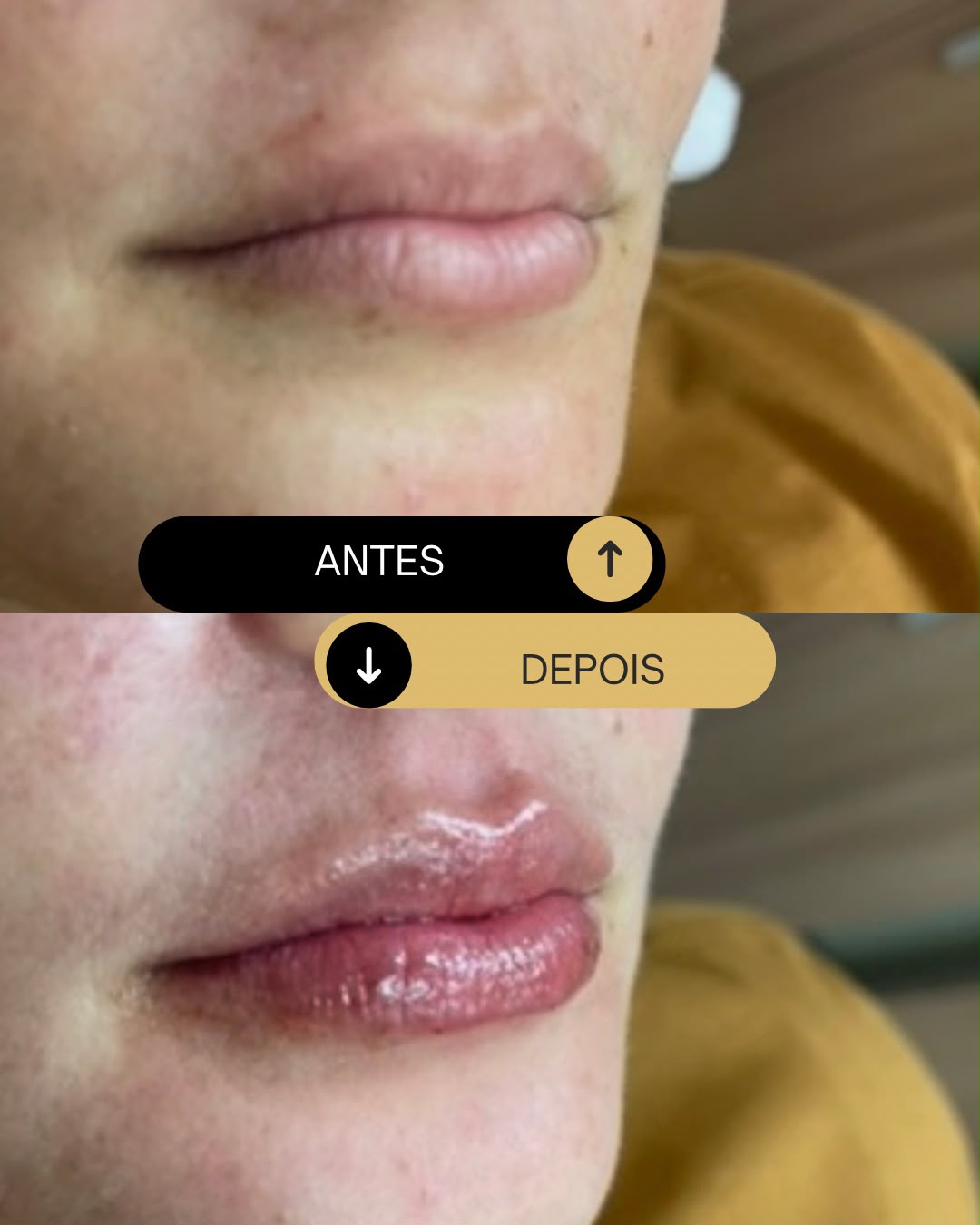 Preenchimento labial com ácido hialurônico antes e depois