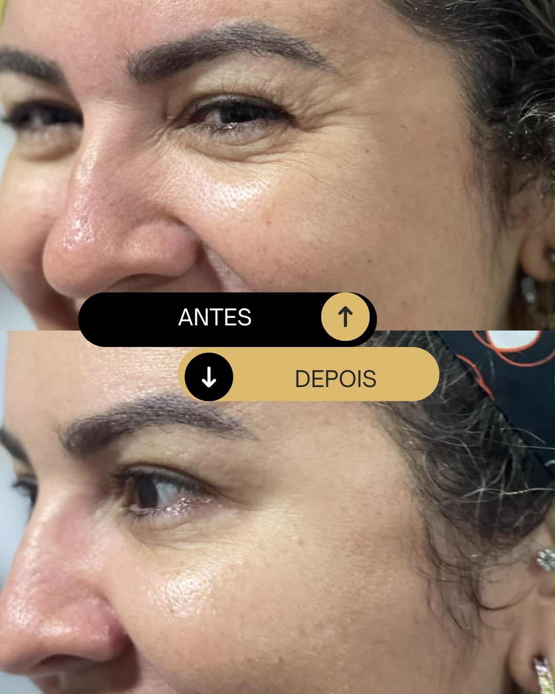 Botox antes e depois — pés de galinha