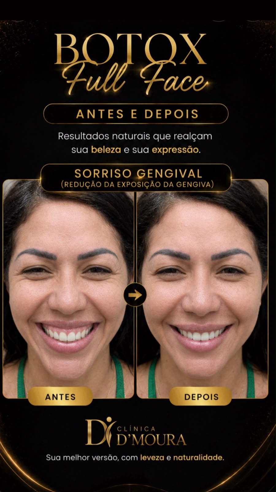 Botox Full Face antes e depois — sorriso gengival