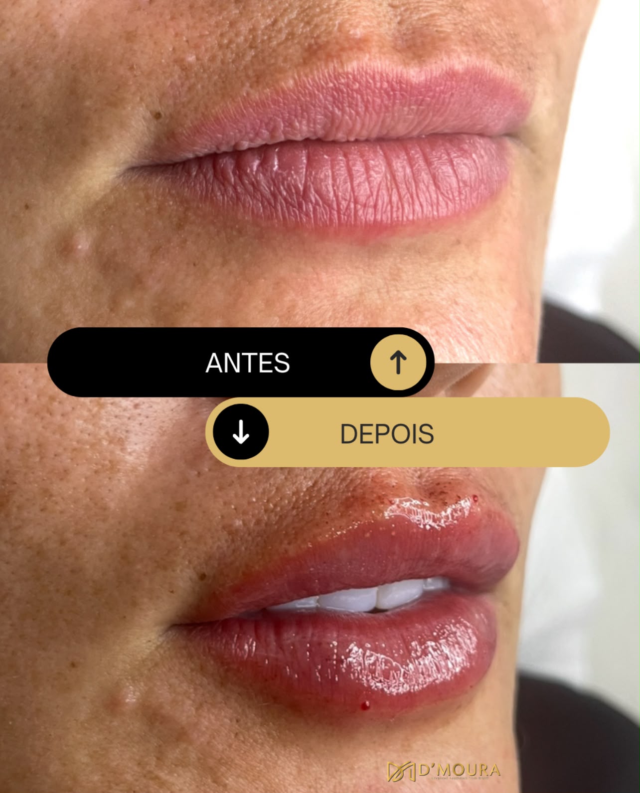 Preenchimento labial com ácido hialurônico antes e depois — perfil