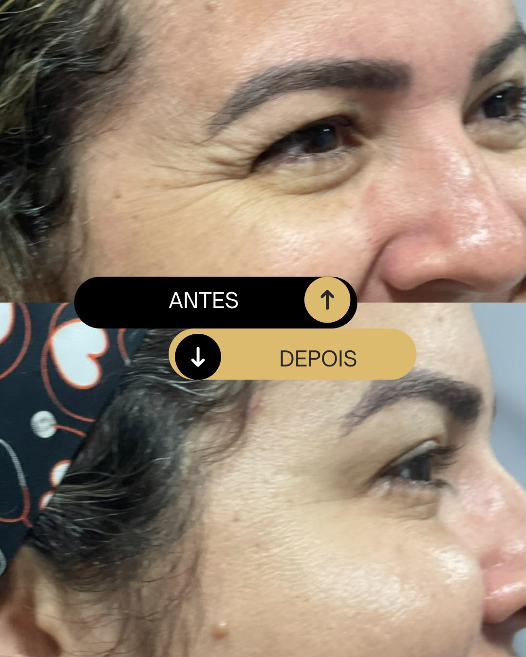 Botox antes e depois — contorno dos olhos