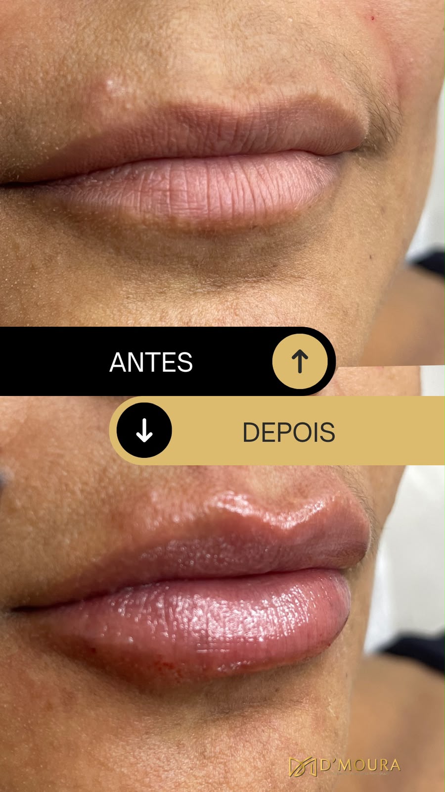 Preenchimento labial com ácido hialurônico antes e depois — harmonia